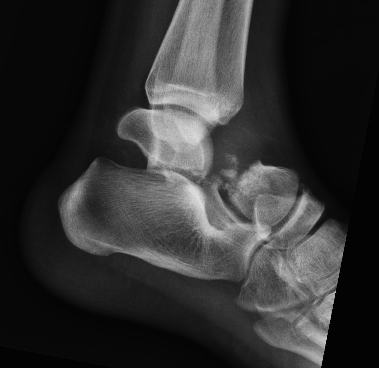 Talus Fracture Type 3